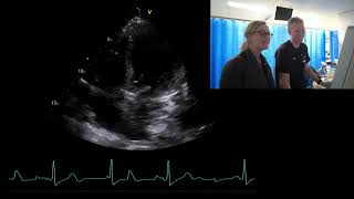 Live case Fluid assessment with echo in patient with septic shock and severe AS [upl. by Chesna736]