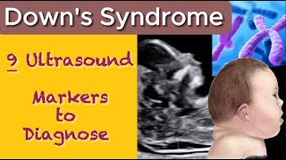 Downs Syndrome  9 Ultrasound Markers to Diagnose Abnormalities in Baby [upl. by Horodko422]