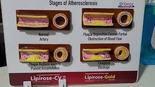 Stages of atherosclerosis [upl. by Imrots747]