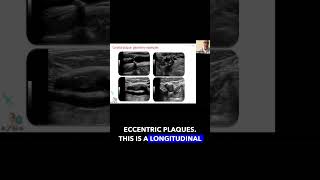 Carotid Plaque Geometry foryou science education vascularultrasound [upl. by Ecinna805]