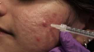 Watch amp Learn Intralesional injections [upl. by Inttirb]