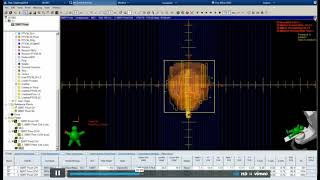 SBRT for Prostate Cancer for Eclipse User [upl. by Jessi800]