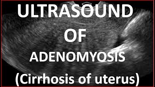 Ultrasound of Adenomyosis [upl. by Eemla210]