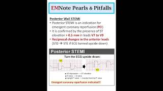 Posterior Wall STEMI doctor medical nursing [upl. by Josie]