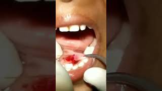 sublingual mucocele Ranula treated by Laser by DrCParya MDS Dip in Laser [upl. by Ulund323]