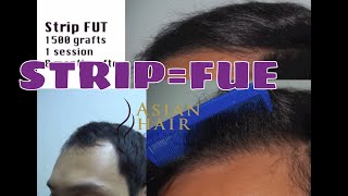 Hair Transplant in the Philippines Manila and Asia [upl. by Fan]