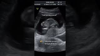 Baby movement in womb pregnancy ultrasound pregnancycare [upl. by Yasmar56]