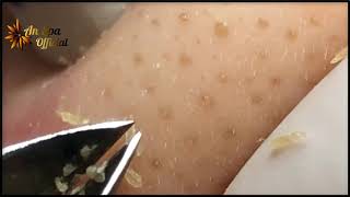 Best Satisfying Nose Plucking Blackheads Whiteheads Removal  Acne Treatment 36 [upl. by Yesnil]