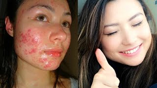 SEVERE ACNE TO CLEAR SKIN  MY ROACUTANE JOURNEY [upl. by Ardyth720]