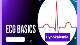 ECG changes in Hypokalemia Causes of Hypokalemia [upl. by Annawad]