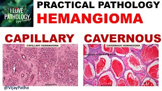 HEMANGIOMA capillary amp Cavernous Clinical features amp Morphology [upl. by Onaicilef155]