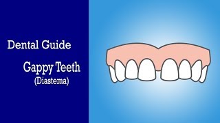 What is a Diastema  BOH Dental Guide to Gapped Teeth [upl. by Dara]