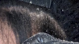 Dandruff Scratching Popping Dandruff Flakes Seborrheic Dermatitis Scalp Flareup ￼ [upl. by Feeley]