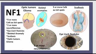 Neurofibromatose de type 1 NF1 Type 2 NF2 Neurinome de lacoustique Schwannome vestibulaire 3 mn [upl. by Penney]