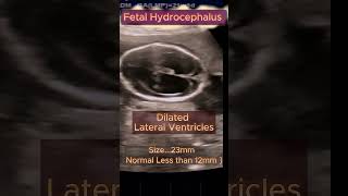 Fetal Hydrocephalus with Spine normal ultrasound pregnancy congenital hydrocephalus [upl. by Konstantin902]