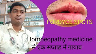 FORDYCE SPOTS cause symptoms and homoeopathic remedies [upl. by Enyt765]