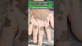 VITILIGO TREATMENT BY VITILIGO CURES vitiligocures vitiligotreatment vitiligo whitespots short [upl. by Chernow]