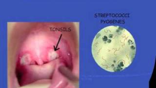 Streptococcal pharyngitis [upl. by Kimmie]