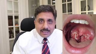 Homeopathic Medicines for Tonsillitis [upl. by Vano]