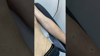 Quick amp Painless Laser Mole Removal shorts [upl. by Nwad506]