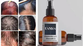 Usmen Hair Loss Treatment Topical Solution Finasteride Minoxidil [upl. by Atse]