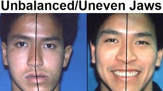 Orthodontic Treatment of Asymmetrical Unbalanced Disproportionate or Unequal Jaw by Dr Mike Mew [upl. by Nnaillek]