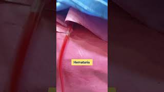 Hematuria vs Clear Urine hematuria urineproblem [upl. by Leasia612]