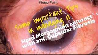 Some Important Tips in managing a Hard Leathery Morgagnian Cataract with a Fibrotic Anterior Capsule [upl. by Silado]