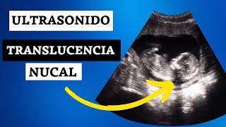 ULTRASONIDO DE TRANSLUCENCIA NUCAL [upl. by Ellenahc]