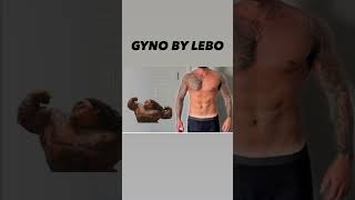 GYNECOMASTIA SURGERY AND BEYOND [upl. by Ardeed487]