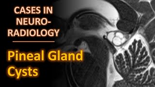 Pineal Gland Cysts imaging findings and approach [upl. by Areta]