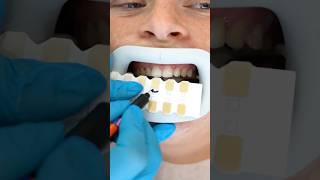 DENTIST APPROVED Teeth Whitening ASMR Experience [upl. by Alomeda]