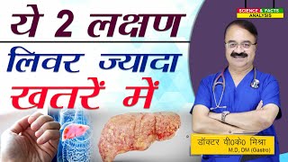 ये २ लक्षण लिवर ज्यादा खतरे में  FATTY LIVER TWO WARNING SIGNS IN LEG AND ABDOMEN [upl. by Eldred593]