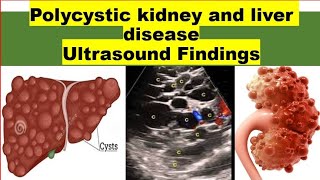 STOP Misdiagnosing Polycystic Kidney and Liver Disease with These Ultrasound Tips [upl. by Akimad]