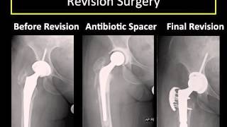 Revision of a Hip Replacement Why How and What to Expect [upl. by Acired149]