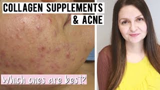 Best Collagen Supplements for Acne Prone Skin  Supplements for Clear Skin [upl. by Stephannie]