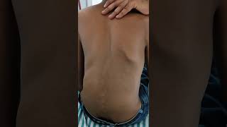 Kyphoscoliosis in a Case of Marfans Syndrome [upl. by Acilef]