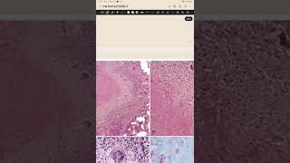 Characteristic Tubercle in TB Histology [upl. by Lytsirhc]