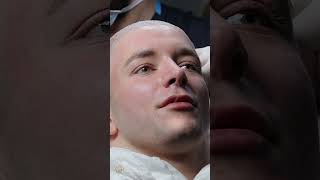 Hair Transplant Operation Process hairtrasnplantturkey nowhairtime hairtransplant [upl. by Assir]