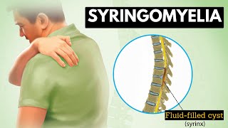 Syringomyelia Everything You Need To Know [upl. by Anolla]