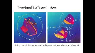 Localizing the culprit artery blockage in patients experiencing a STEMI ECG analysis  MI [upl. by Enymzaj]