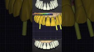 💻🦷📏 Ajustes finos no posicionamento dos dentes exocad cadcam dental dentist dentistry [upl. by Anawahs]