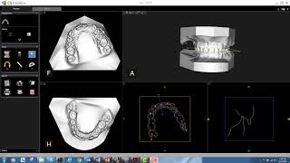 CS Model  Registration of Orthodontic Models CS 3600 [upl. by Dj]