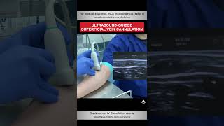 Ultrasoundguided Superficial Vein Cannulation  shorts ivcannulation anesthesiology nurse [upl. by Noseaj121]