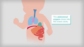 What is congenital diaphragmatic hernia [upl. by Aneeuqahs5]