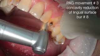 Esthetic anterior crown by Cerec and PAG technique  method amp live clinical case [upl. by Jahn]