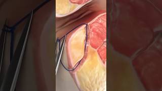 Laser Closure of Fistula Tract FiLaC Video credit SurgMedia Youtubecom [upl. by Nove]