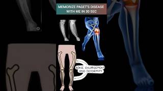 Mnemonic to Learn Pagets disease of Bone🦴pathology bone orthopedics mbbs doctor l [upl. by Eceinej]