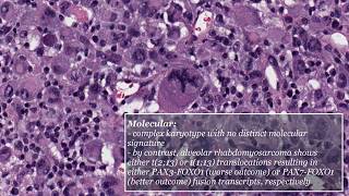 Pleomorphic Rhabdomyosarcoma [upl. by Gaelan]