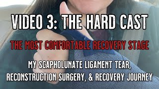 Scapholunate Ligament Tear and Reconstruction  Video 3 hard cast update [upl. by Underwood78]